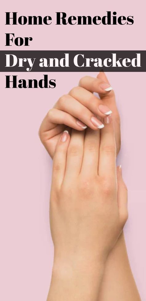 Home Remedies For Severely Dry and Cracked Hands| Dry Hands Remedy Homemade Soft Hands Remedy, How To Get Rid Of Dry Hands, Dry Cracked Hands Remedy, Cracked Hands Remedy, Chapped Hands Remedy, Hand Remedies, Dry Hands Remedy, Cracked Fingers, Dry Skin Diy