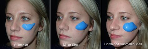 Cheek Implants Richmond VA | Facial Fillers | Midface Implants Cheek Implants Before And After, Cheek Implants, Cheek Bones, Facial Proportions, Silicone Implants, Tear Trough, Facial Surgery, Facial Fillers, Fat Transfer