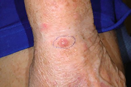 Basel Cell Carcinoma Pictures, Skin Diseases Pictures, Basil Cell Carcinoma, Skin Conditions Pictures, Skin Disease Pictures, Renal Cell Carcinoma, Skin Symptoms, Basal Cell, Kill Ants