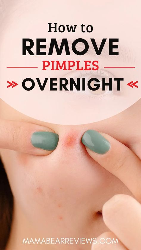 how to remove pimple overnight Quick Pimple Remedy, Fastest Way To Get Rid Of Pimples, How To Get Rid Of Pimples Fast At Home, Zit Remedy Overnight, Remove Pimples Overnight, Nose Pimples, Inflamed Pimple, To Remove Pimples, Big Pimple