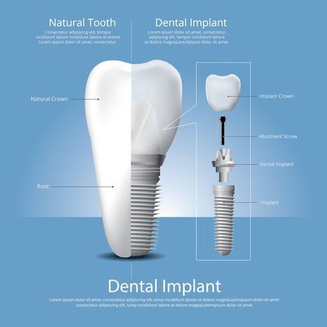 Dentist Ideas, Dental Posts, Dental Posters, Best Dental Implants, Remedies For Tooth Ache, Human Teeth, Teeth Implants, Dental Bridge, Family Dental