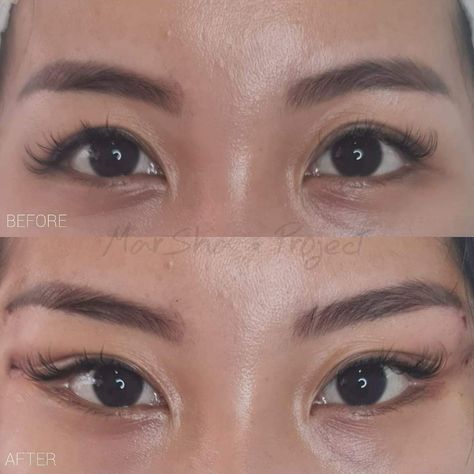 Cat Eye Surgery Before And After, Fox Eye Surgery, Beauty Surgery, Eye Lift Surgery, Bambi Makeup, Face Plastic Surgery, Lip Surgery, Foxy Eyes, Rhinoplasty Nose Jobs