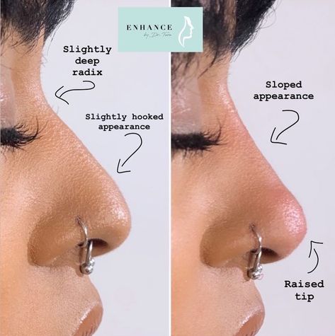 Nubian Nose, Dream Nose, Non Surgical Nose Job, Nose Types, Nose Jobs, Curved Nose, Yoga Information, Nose Shapes, Nose Job