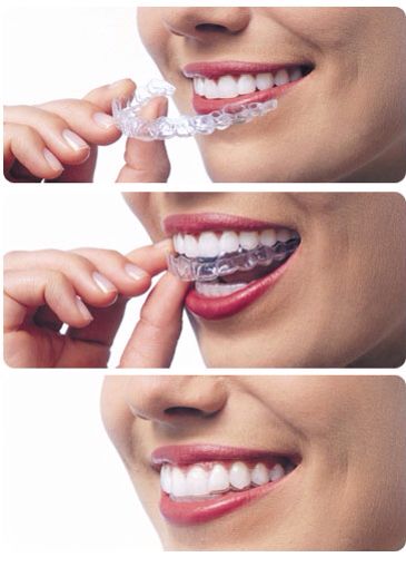 Invisalign  Aligners Invisalign Aligners, Dental Social Media, Dental Images, Dental Posters, Invisible Braces, Dental Fun, Dental Braces, Straight Teeth, Metal Braces