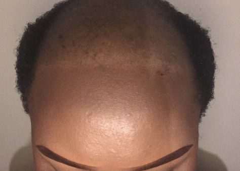 Alopecia manifests in thinning all over the head. A receding hairline is not common in women like it is in men. Receding Hairline Women, Black People Hair, Bad Hairline, Natural Braided Hairstyles, Natural Braids, Receding Hairline, Hair Issues, Male Pattern Baldness, Pattern Baldness