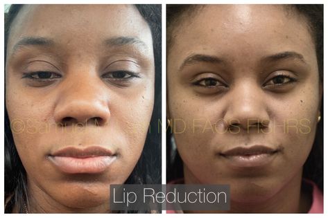 Lip Reduction Before After, Lip Reduction, Upper Lips, Reduce Hair Growth, Upper Lip Hair, Plano Texas, Lower Lip, Before After Photo, Lip Hair