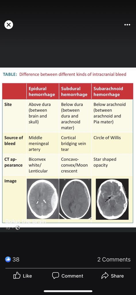 Circle Of Willis, Subarachnoid Hemorrhage, Speech Therapy, Star Shape, Nursing, Bones, Brain