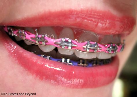 Cute braces colors for teens- girls Chain Braces, Power Chain Braces, Braces Girl, Braces Colors Combinations, Braces Color Wheel, Red Braces, Power Chain, Cute Braces Colors, Braces Cost