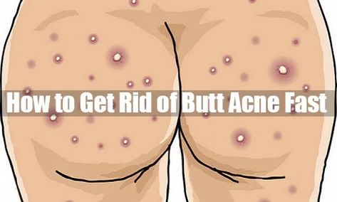 How to Get Rid of Butt Acne Fast - Whydoihaveacne.com But Acne How To Get Rid Of, How To Get Rid Of Buttocks Acne, But Acne, Tretinoin Before And After, Buttocks Acne, Acne Scrub, Skin Lesions, Diy Acne, Spa Ideas