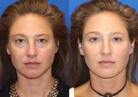 Fat Transfer Before & After Gallery Fat Grafting Face, Fat Transfer To Face, Breast Fat Transfer, Jaw Reduction Surgery, Aesthetic Procedures, Cheek Fat, Body Surgery, Plastic Surgery Fail, Korean Plastic Surgery