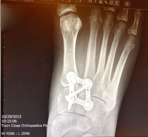 Lisfranc Injury, Broken Foot, Sprained Ankle, Surgery Recovery, After Surgery, Things To Know, Surgery, Health Tips