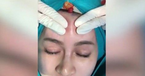 Boil Popping Videos, Squeezing Zits, Zit Popping Video Faces, Huge Pimple, Back Pimples, Covering Acne, Cystic Pimple, Blind Pimple, Pimples Under The Skin