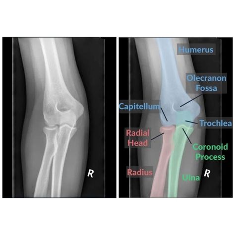 Elbow Xray, Xray School, Diagnostic Radiography, Veterinary Radiology, Radiography Student, Rad Tech Student, Radiology Schools, Medical Radiography, Radiologic Technology