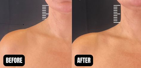 Trap BOTOX aka TrapTox in Santa Rosa and Healdsburg Slimmer Neck, Laser Hair Removal Face, Botox Results, Face Plastic Surgery, Mommy Makeover Surgery, Botox Before And After, Plastic Surgery Photos, Aesthetic Nurse, Face Fillers