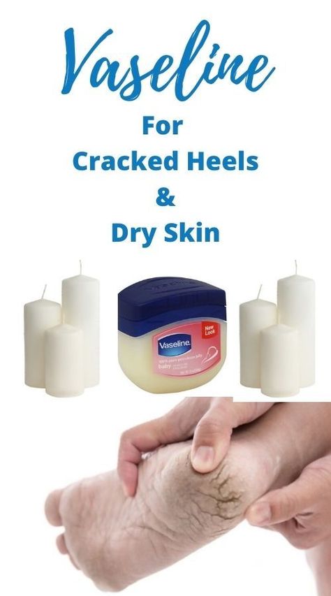 Feet Cracks Remedies, Cracked Feet Remedies Heels, How To Soften Heels, How To Heal Cracked Heels, Dry Heels How To Get Rid Of, Foot Soak For Cracked Heels Diy, Cracked Heels Remedy Overnight, Cracked Heel Remedy, Feet Repair