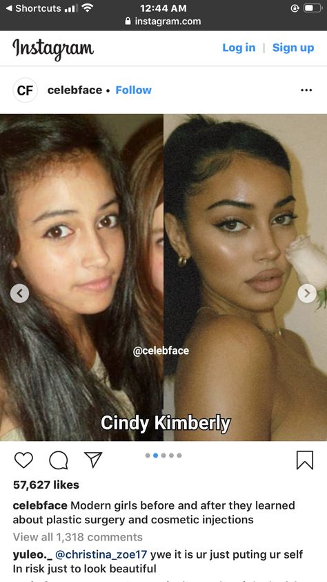 High Vs Low Nose Bridge, Cindy Kimberly Before And After Surgery, Alarplasty Before After, Nose Botox Before And After, Nose Filler Before After Non Surgical, Nose Filler Before After, Under Eye Filler Before And After, Long Philtrum, Glow Up Before And After