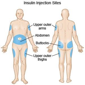 Insulin Injection Sites, Insulin Injection, Injection Sites, Nursing Fundamentals, Nursing Skills, Psychiatric Nursing, Nursing School Survival, Fundamentals Of Nursing, Nursing School Studying