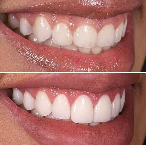 Whiten Teeth Fast, I Healed, Porcelain Veneers, Whiten Teeth, Receding Gums, Before Going To Bed, Tooth Decay, Cavities