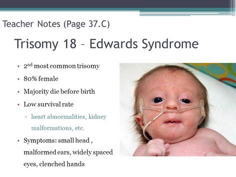 Edwards Syndrome, Nursing Study Guide, Neonatal Nurse, Respiratory Therapy, Respiratory Therapist, Medical School Essentials, Medical School Studying, Medical Knowledge, Medical Education