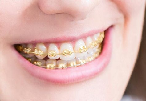 Dental Braces Colors, Braces Ideas, Gold Braces, Lingual Braces, Piercings Bonitos, Cute Braces Colors, Adult Braces, Kids Braces, Getting Braces