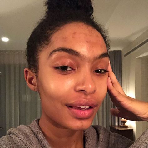 Yara (يارا‎) Shahidi (@yarashahidi) • Instagram photos and videos No Makeup Acne, Makeup With Acne, Girl With Acne, Acne Women, Makeup Acne, Zero Makeup, Celebs Without Makeup, Acne Makeup, Natural Makeup Look