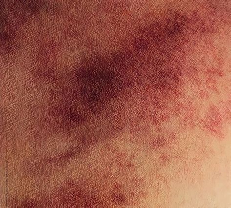 Chemical Burn Scar Reference, Red Marks On Skin, Eye Bruising, Knee Bruising, Arlo Core, Tiffany Maxwell, Scar Aesthetic, Scar Reference, Marvel Peter Parker