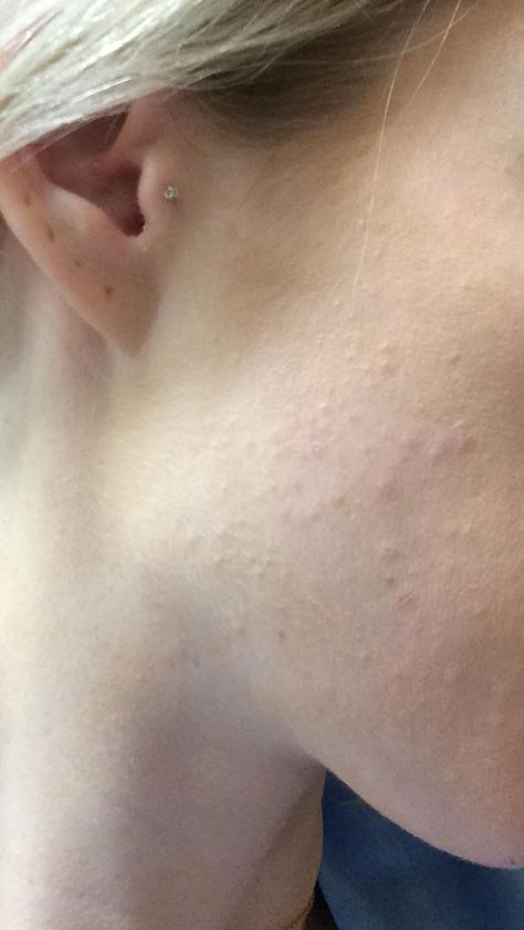 [Skin Concern] HELP. Today i woke up with a ton of tiny little bumps on the right side of my face. Im in a wedding on Saturday so I'm frantic to make them go away. Any suggestions? I don't believe they're whiteheads/blackheads but I did sleep in a hair mask they make have rubbed onto my pillow Chin Bumps, Tiny Bumps On Face, Prevent Pimples, My Pillow, Skin Care Solutions, Anti Aging Skin Products, Skin Concern, Simple Skincare, Skin Care Essentials