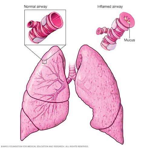 Asthma - Symptoms and causes Asthma Attack, Thyroid Imbalance, Lung Conditions, Allergy Asthma, Asthma Symptoms, Health Hacks, Pulmonary Disease, Asthma Attacks, Lung Disease