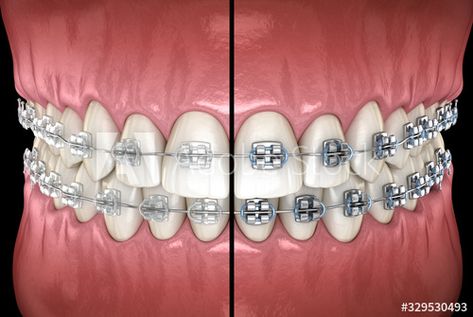 Stock Image: Clear braces versus Metal braces. Medically accurate dental 3D illustration, concept. Different Types Of Braces, Silver Braces, Dental Wallpaper, Ceramic Braces, Braces Cost, Types Of Braces, Traditional Braces, Invisible Braces, Clear Braces