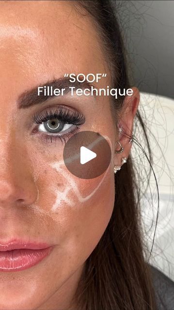 SKYN Aesthetics Consultants • Clinic & Academy• (Jenna Leigh) on Instagram: "Tired of looking like you haven’t slept?? Eye creams and skin boosters not doing the trick - but you don’t want tear trough filler??   Say hello to the “SOOF” Filler Technique!  The SOOF is the SubOrbicularis Oculi Fat pad, and targeting it with filler can lift & smooth undereyes: Bye-bye shadows and hollows.  Using this technique helps improve under-eve dark circles without injecting into the delicate tear trough area!   #teartroughs #antiageing #sooftechnique #darkcircles #undereyes #undereyefiller #undereyebags #undereyes #darkcirclesbegone #darkcircletreatment #aestheticseducation #educationmatters #injectoreducation" Tear Trough Filler Before After, Under Eye Filler Before And After, Tear Trough Filler, Under Eye Fillers, Tear Trough, Eye Creams, Under Eye Bags, Bye Bye, Dark Circles