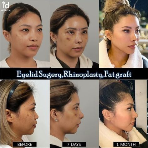 Face Transformation, Toxic Positivity, Korean Plastic Surgery, Rhinoplasty Before And After, Face Surgery, Fat Grafting, Celebrity Plastic Surgery, Korean Face, Double Eyelid