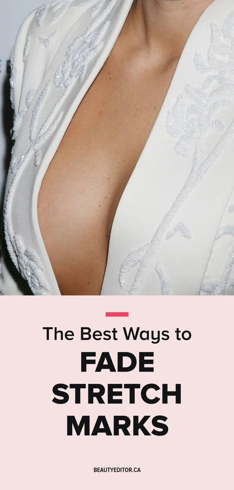 The Best Ways to Fade Stretch Marks - The Skincare Edit Stretch Mark Cream Pregnancy, How To Fade, Wrinkle Remedies, Skincare Secrets, Stretch Mark Cream, Retinol Cream, Stretch Mark, Skin Secrets, Effective Skin Care Products