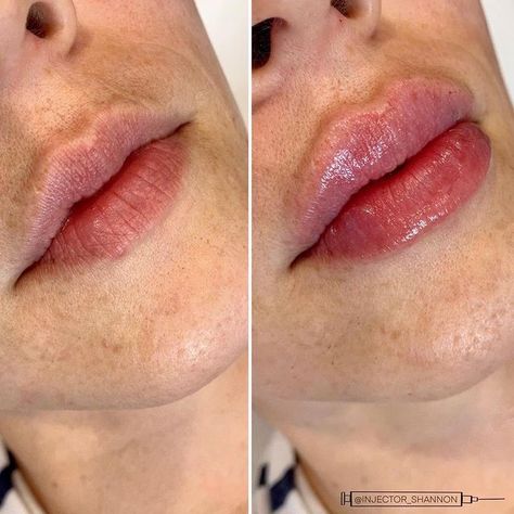 Lips After Fillers, Heart Shaped Lip Filler, Lipfiller Before After, 0.5 Ml Lip Filler Before And After, Lip Filler Before And After, Lip Fillers Juvederm, Botox Injection Sites, Lip Surgery, Heart Shaped Lips