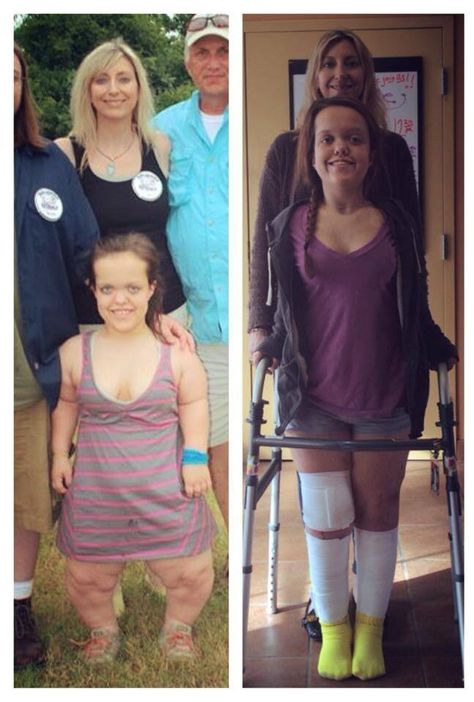 Before and After Limb Lengthening Limb Lengthening, Pole Fitness, Fitness Transformation, Body Fitness, Stubborn Belly Fat, Interesting Stuff, Brunette Hair Color, Lose Belly, Plastic Surgery