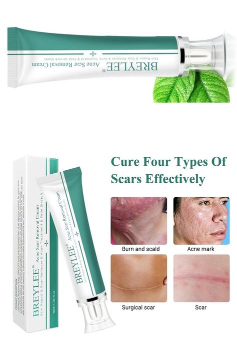 Face Pimples, Acne Scar Removal Cream, Hypertrophic Scars, Scar Remover, Scar Removal Cream, Pimple Scars, Scar Cream, Pimples On Face, Acne Scar