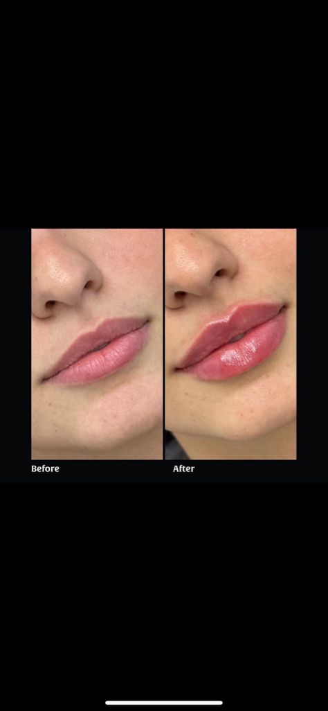 Lip Fuller Shapes, Lips Filer Shape, Lip Filler Heavy Upper Lip, Lip Fillers Heart Shape, Big Lip Filler, Heart Shape Lips Fillers, Small Lips Lip Filler, Lip Filler 2ml, Lip Filler Shape Ideas Pouty