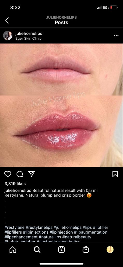 Very Natural Lip Filler, Heart Shape Lips Fillers, Lip Filler Shape Ideas Natural, Lip Filler Inspiration Natural, Lip Filler Inspo Pics, Lip Filler Shape Ideas 1ml, 1ml Lip Filler Before And After, Heart Shaped Lip Filler, Hip Filler