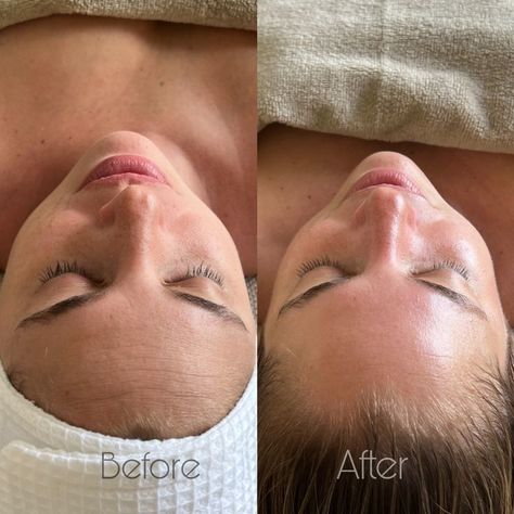 Hydro Facial Before And After, Skin Care Before And After, Facials Before And After, Facial Before And After, Vanity Ikea, Skin Studio, Facial Therapy, Diy Makeup Vanity, Face Machine