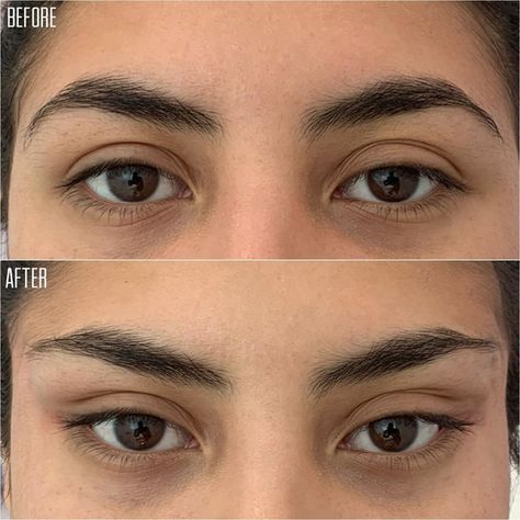 Discover Aesthetics on Instagram: “NON SURGICAL BROW LIFT with PDO threads! 👁 Follow @discover.aesthetics for more!⠀⠀⠀⠀⠀ -⠀⠀⠀⠀⠀ The #1 Destination to discover the Wide Array…” Eye Lift Surgery, Botox Brow Lift, Pdo Threads, Botox Lips, Face Surgery, Eyebrow Lift, Beauty Procedures, Facial Fillers, Facial Contouring