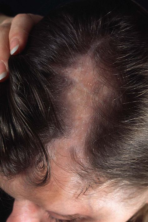 Frontal fibrosing alopecia is a form of alopecia (hair loss) that affects the area where the hairline meets the front of the scalp. Scarring Alopecia, Skin And Hair Clinic, Hairstyles And Haircuts, Scarring, Lost Hair, Acne Remedies, Hair Restoration, Best Hairstyles, My Hair