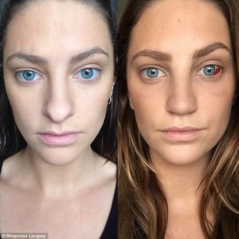 Rhiannon Langley nose job blogger blogger shares diary of Thailand surgery Wide Nose Rhinoplasty, Kpop Plastic Surgery, Jaw Reduction Surgery, Nose Surgery Rhinoplasty, V Line Surgery, Bulbous Nose, Plastic Surgery Fail, Bicep Tattoo Men, Korean Plastic Surgery