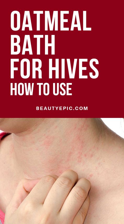 Oatmeal Bath Remedy for Hives: How to Use Hives Remedies, Allergies Remedies, Chest Congestion Relief, Remedies For Chest Congestion, Oatmeal Bath, Natural Teething Remedies, Congestion Relief, Allergy Remedies, Chest Congestion