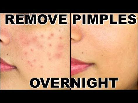 Doterra Acne, Remove Pimples Overnight, To Remove Pimples, Remove Pimples, Pimples Overnight, Pimples Remedies, Skin Care Routine For 20s, Natural Acne Remedies, Natural Acne