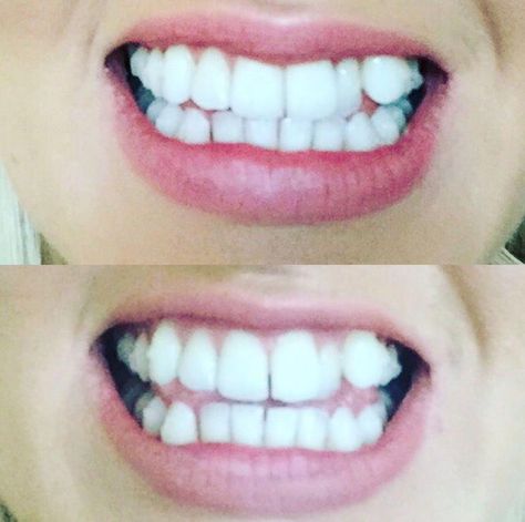 Invisalign Progress, Invisalign Attachments, Invisalign Hacks, Invisalign Tips, Pink Sparkle Background, Retainer Cleaner, It Gets Easier, Sparkles Background, Soft Foods