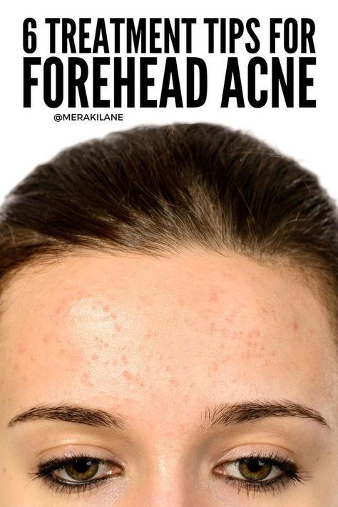 You have to get to the root cause of your acne to make real progress in clearing it. Here's what your breakouts mean and how to treat them. Forehead Breakout, Cheek Acne, Head Acne, Acne Cleaning, Dilated Pores, Teenage Acne, Forehead Acne, Clean Blackheads, Home Remedies For Acne