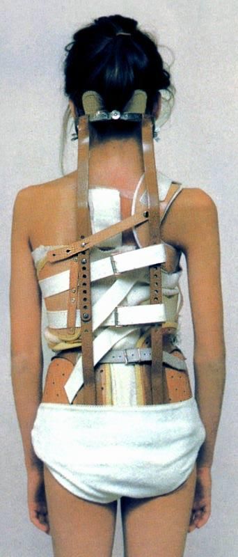 Milwaukee spinal brace with ancillary and axillary pads attached. Milwaukee Brace, Orthopedic Brace, Pelvic Girdle, Back Brace, Battle Scars, Living Dolls, Braces, Overall Shorts, Back Pain