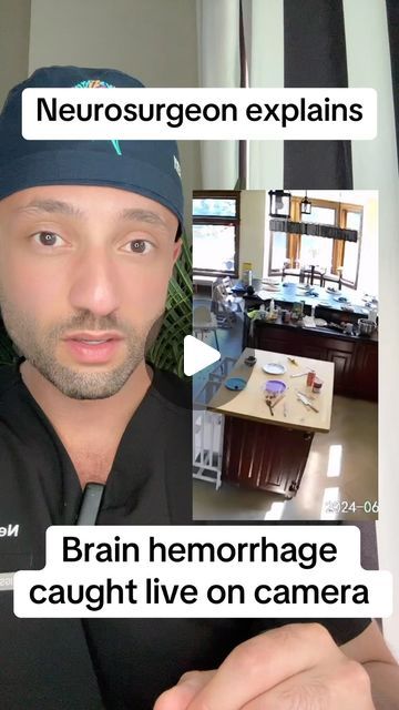 Dr. Z 🧠 Neurosurgery on Instagram: "Subarachnoid hemorrhage can be fatal if left untreated. #medical #doctor #aneurysm #brainaneurysm #brain #brainhealth shout out to @smartasthomass for the footage." Subarachnoid Hemorrhage, Medical Doctor, July 15, Brain Health, Body Health, Biology, Shout Out, Brain, Medical