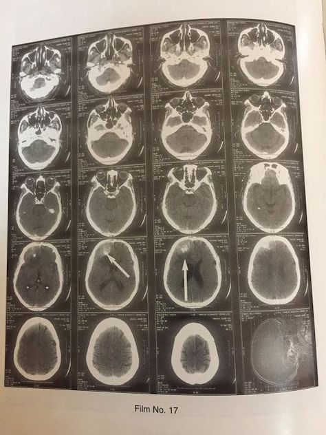 Brain Scans, Hospital Admit, Brain Images, Hospital Admit Hand Pics, Head Pain, Brain Scan, Mri Scan, Ct Scan, Blood Art