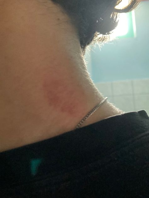 Hickey On Boy, Hickey Neck Tattoo, Hickey Neck Aesthetique, Heart Made Of Hickeys, Neck Bite Boyfriend, Neck Full Of Hickeys, Hicks On Neck, Hickies Neck Aesthetic, Hickies Neck