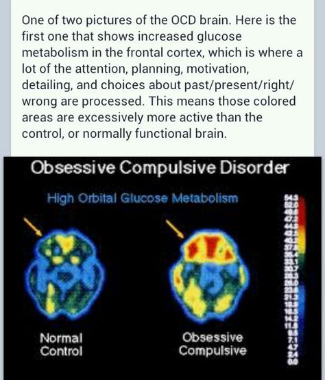 OCD brain Ocd Facts, Ocd Brain, Ocd Quotes, Ocd Thoughts, Ocd Therapy, Understanding Emotions, Mental Health Facts, School Psychology, Mental Health Support